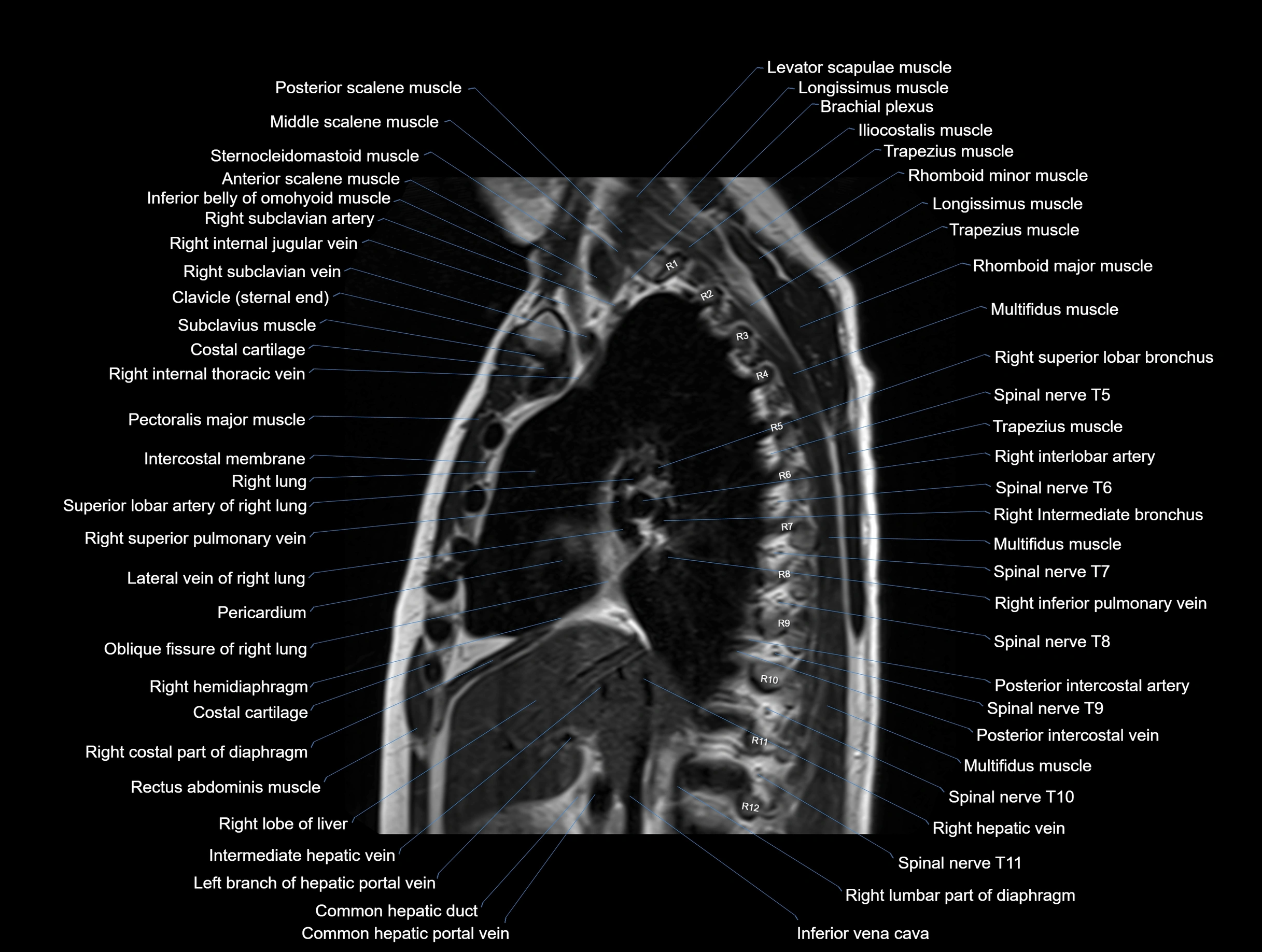 MRI chest (thorax) coronal  cross sectional anatomy 3T radiology  image-img-00001-00016.webp